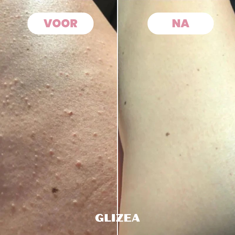 Scheermes Glizea™